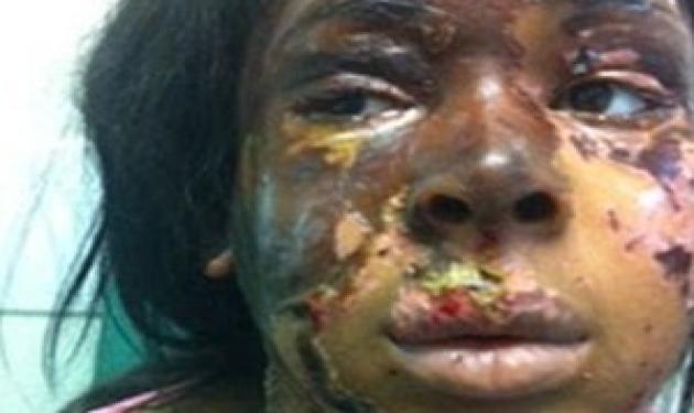 Υπάλληλος της Victoria Secret’s δέχτηκε επίθεση με οξύ στο πρόσωπο! Φωτογραφίες!
