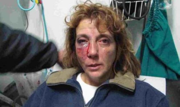 Διαδηλώτρια θύμα της βίας των ΜΑΤ: Έβλεπα το γκλομπ να πέφτει στο πρόσωπό μου!