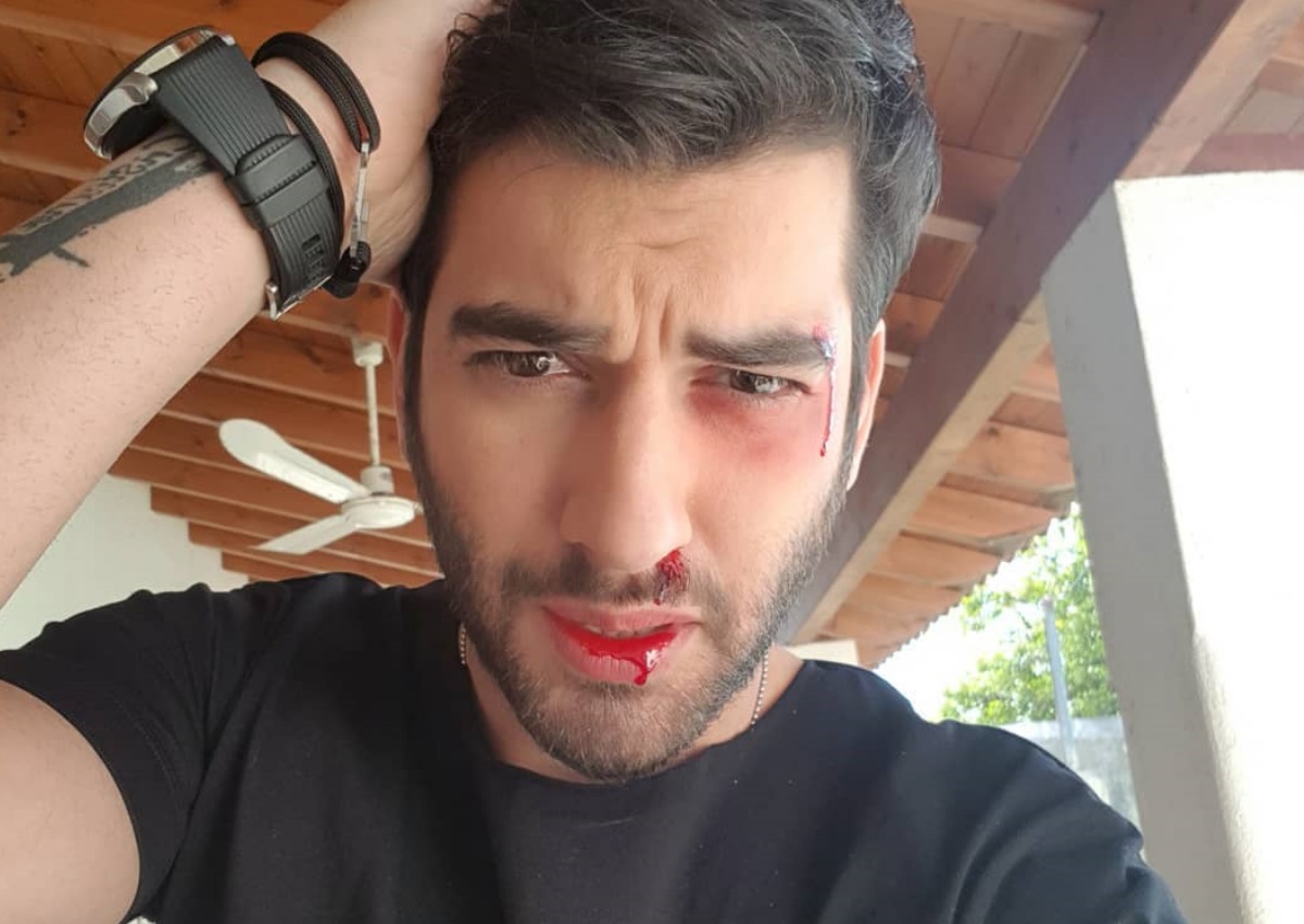 Μάνος Ιωάννου: Ο καβγάς και ο… τραυματισμός του! Δες τι έγραψε στο Instagram ο ηθοποιός