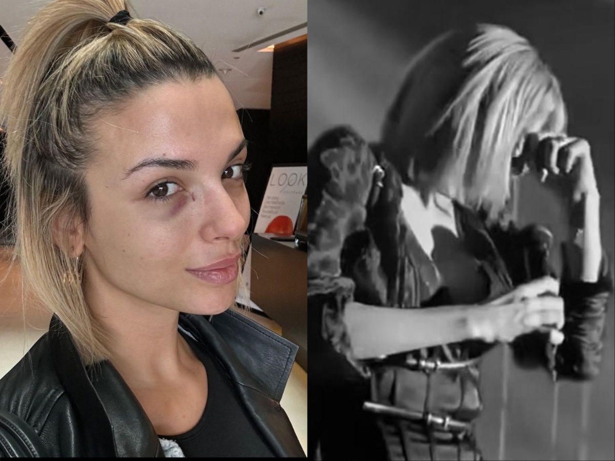 Κατερίνα Λιόλιου: Η φωτογραφία με μελανιασμένο μάτι μετά το περιστατικό με το αιχμηρό αντικείμενο – «Η κατάστασή μου»